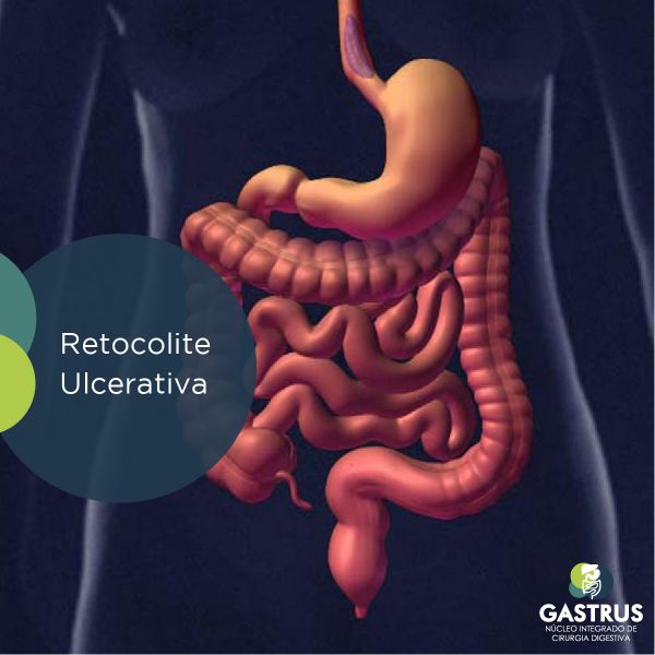 Retocolite Ulcerativa